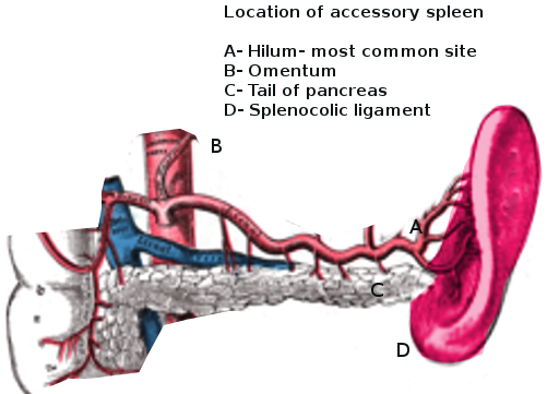 Accessory spleen