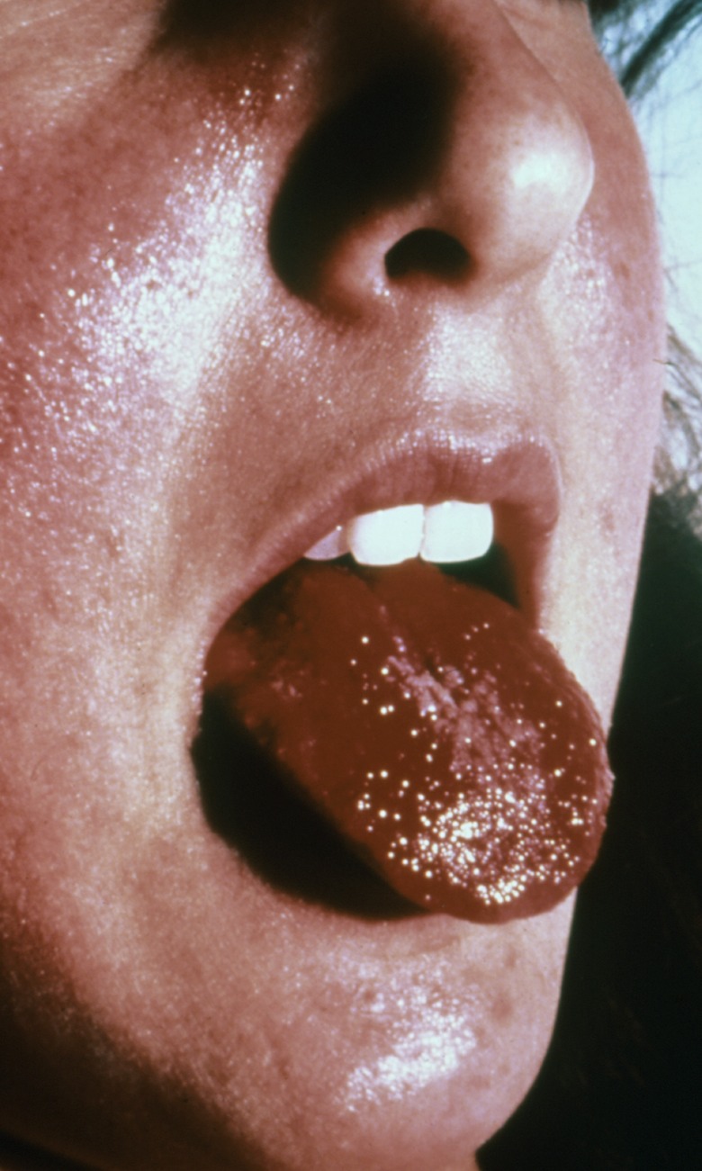 Strawberry Tongue caused by S. Aureus in a patient with Toxic Shock Syndrome