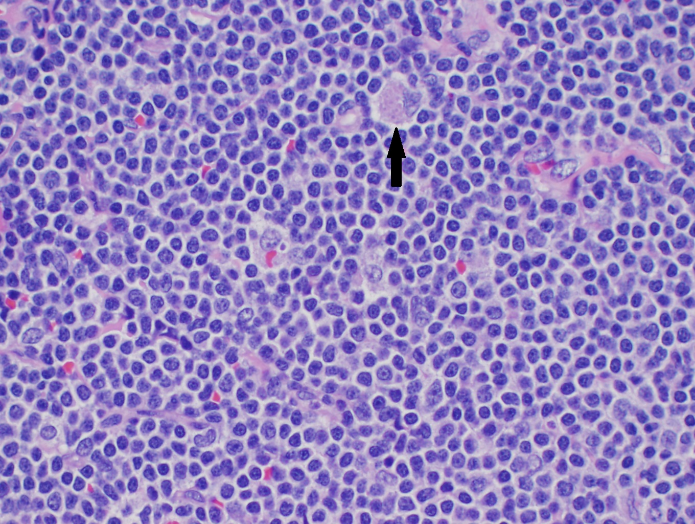 High power H&amp;E of mantle cell lymphoma showing monotonous mature lymphocytes with mildly irregular nuclei