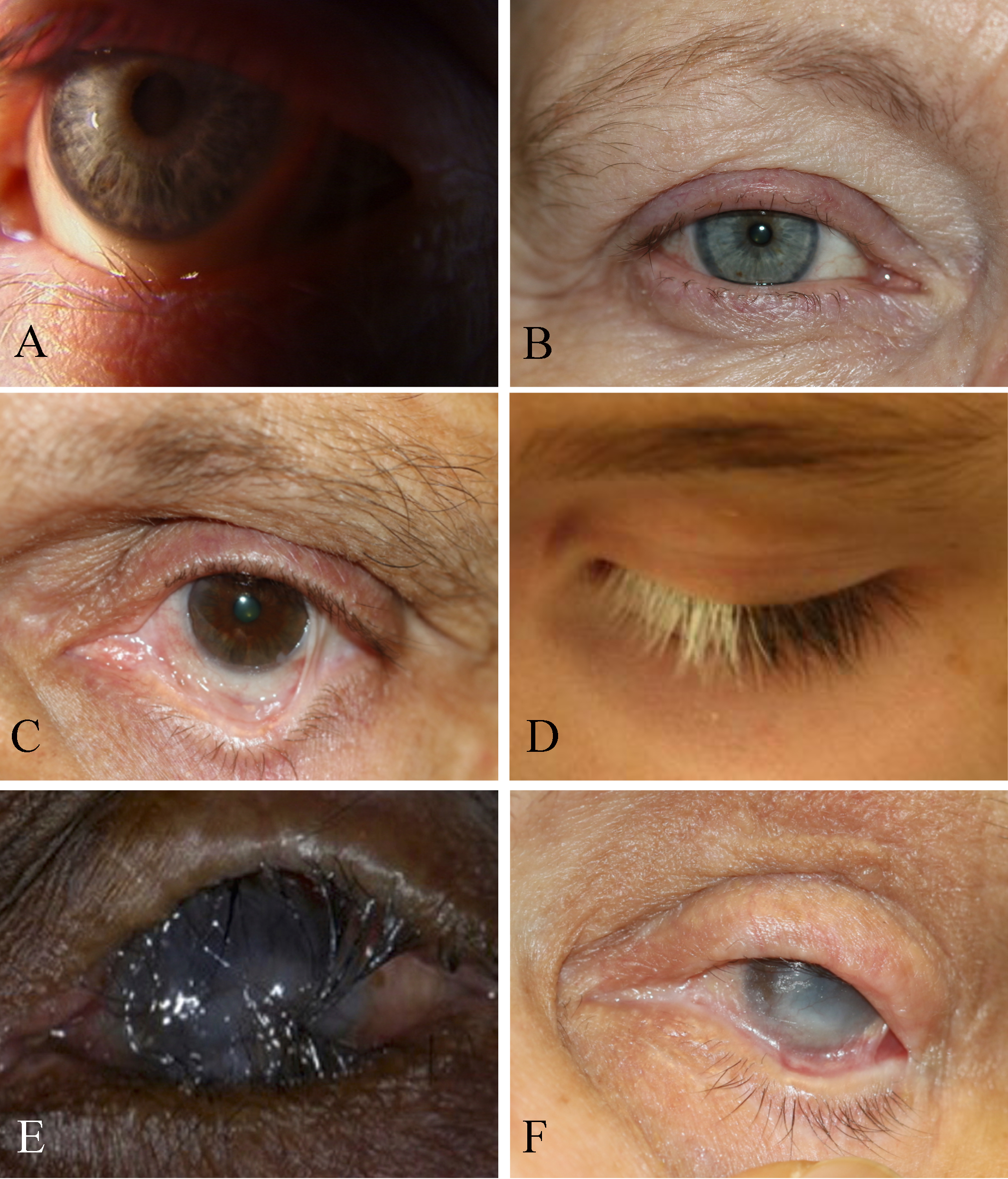 A.	Trichiasis. The eyelid itself is not turning in but the lashes are pointing inwards.
B.	Madarosis. Short stubby lashes of different sizes indicates trichotillomania
C.	Symblepharon with secondary trichiasis, fornix shortening, cicatricial entropion
D.	Poliosis
E.	Trachoma with corneal opacification
F.	Pemphigoid disease with cicatricial entropion, trichiasis, ankyloblepharon, corneal scarring, dry eye
