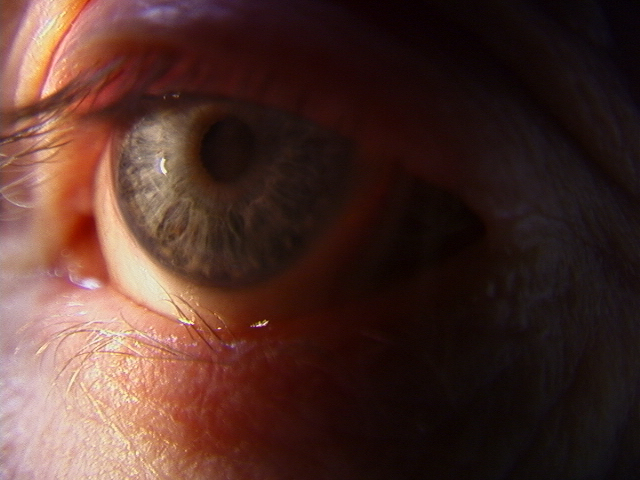 Trichiasis at a site of prior trauma to the lower eyelid