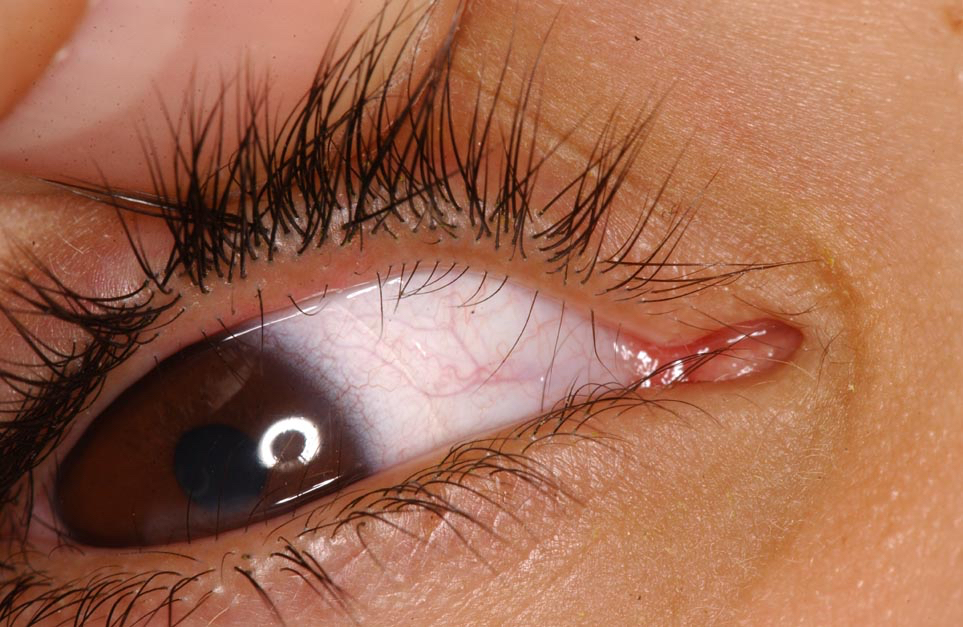 Congenital distichiasis with a separate row of lashes growing out of the Meibomian orifices