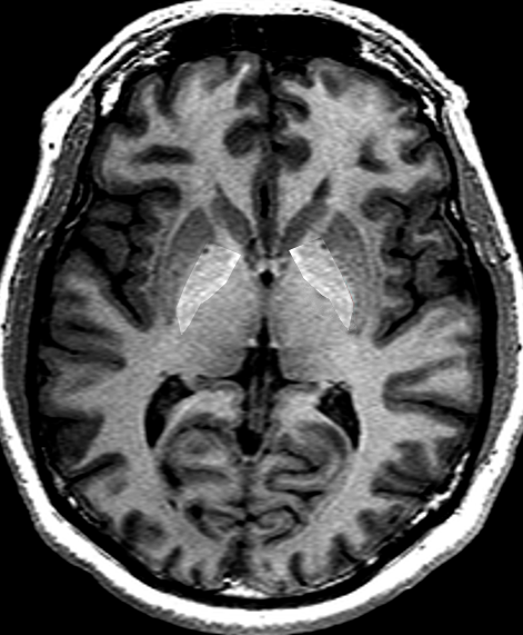 MRI of thalamus