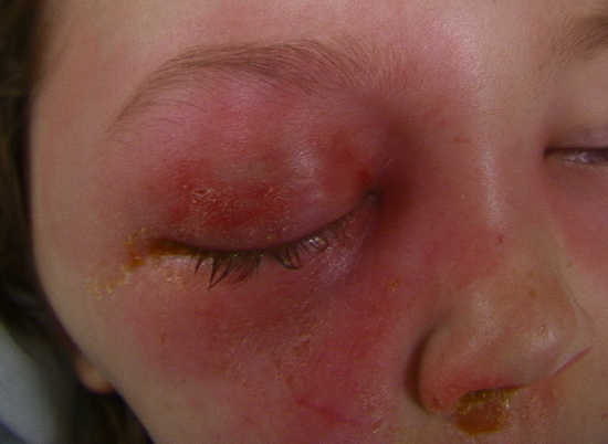 14-year-old female presents with swelling of the right periorbital tissues developing over one week with nasal congestion, pain, double vision and difficulty opening the eyelids and decreased vision. Note the right nasal discharge. Diagnosis cellulitis of the right orbit.