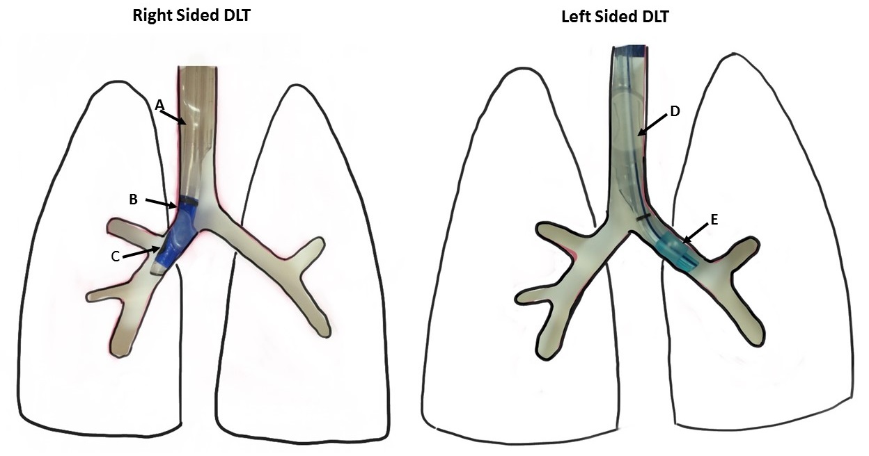 Optimal position of right and left sided double lumen tubes (DLTs).
A: Tracheal cuff of Right DLT; B: Bronchial cuff of Right DLT; C: The slot of the endobronchial lumen properly aligned with the opening of the right upper lobe bronchus.
D: Tracheal cuff of Left DLT; E: Bronchial cuff of Left DLT