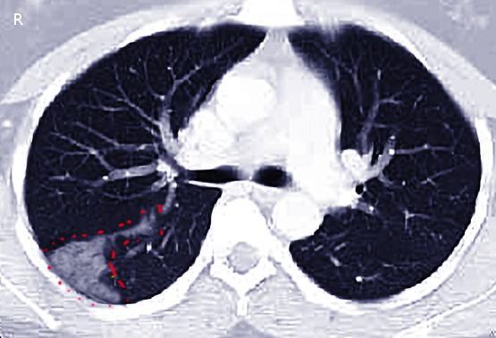 Pulmonary infarction caused by a pulmonary embolism after a hip fracture.