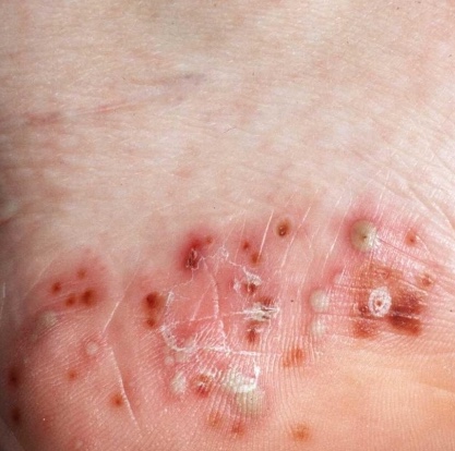 Photo of pustular psoriasis showing multiple yellowish pustules with surrounding erythema.