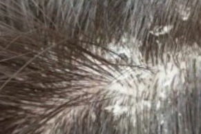 Tinea capitis of the scalp showing black-dots picture.