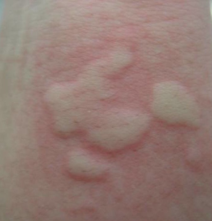 Case of urticaria showing urticarial wheels