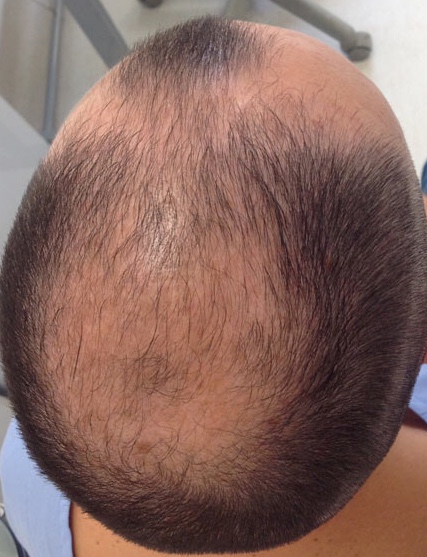 male-pattern androgenetic alopecia with loss of hair from frontal, temporal and central scalp areas.