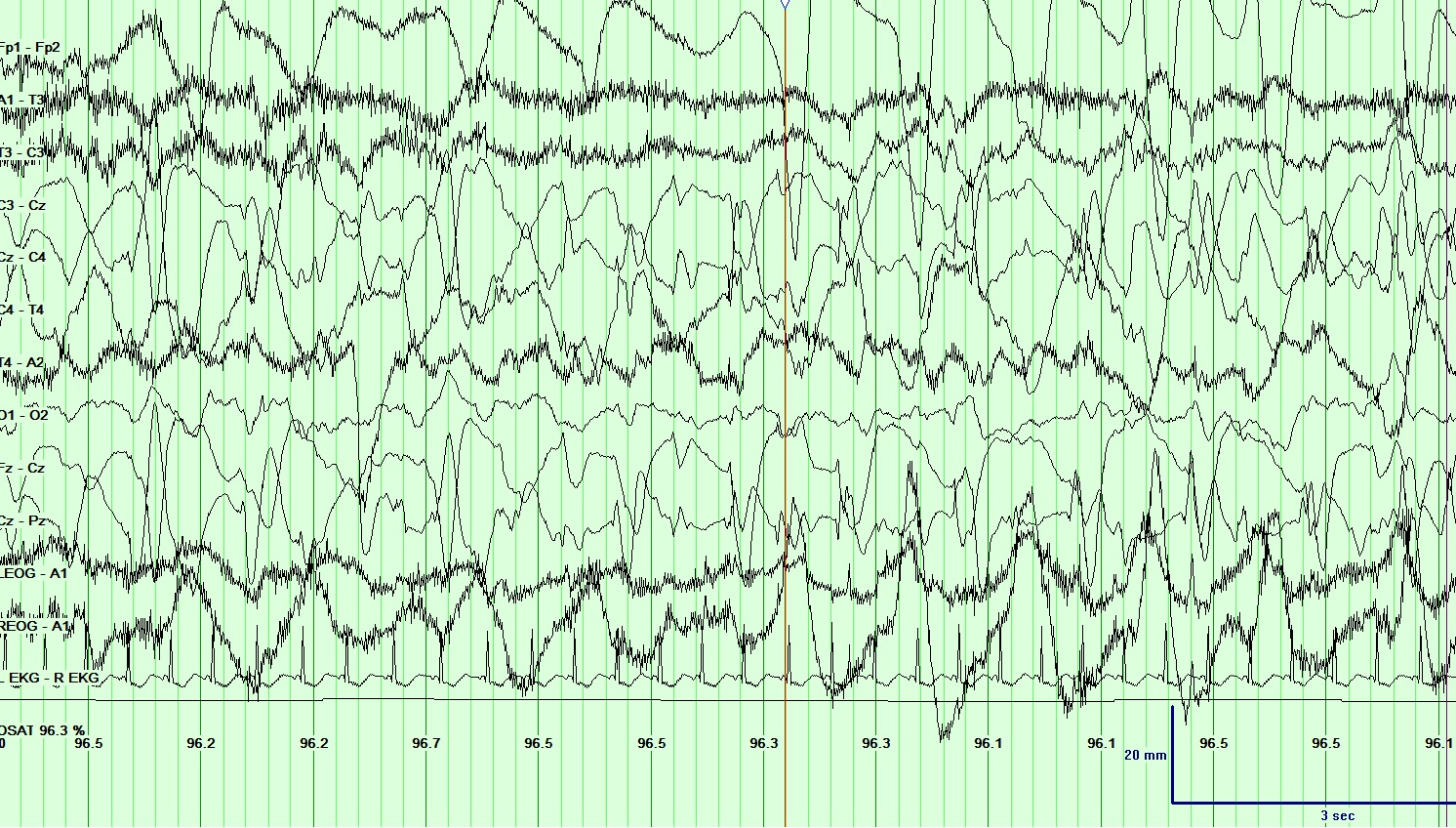 EEG Neonatal seizure
