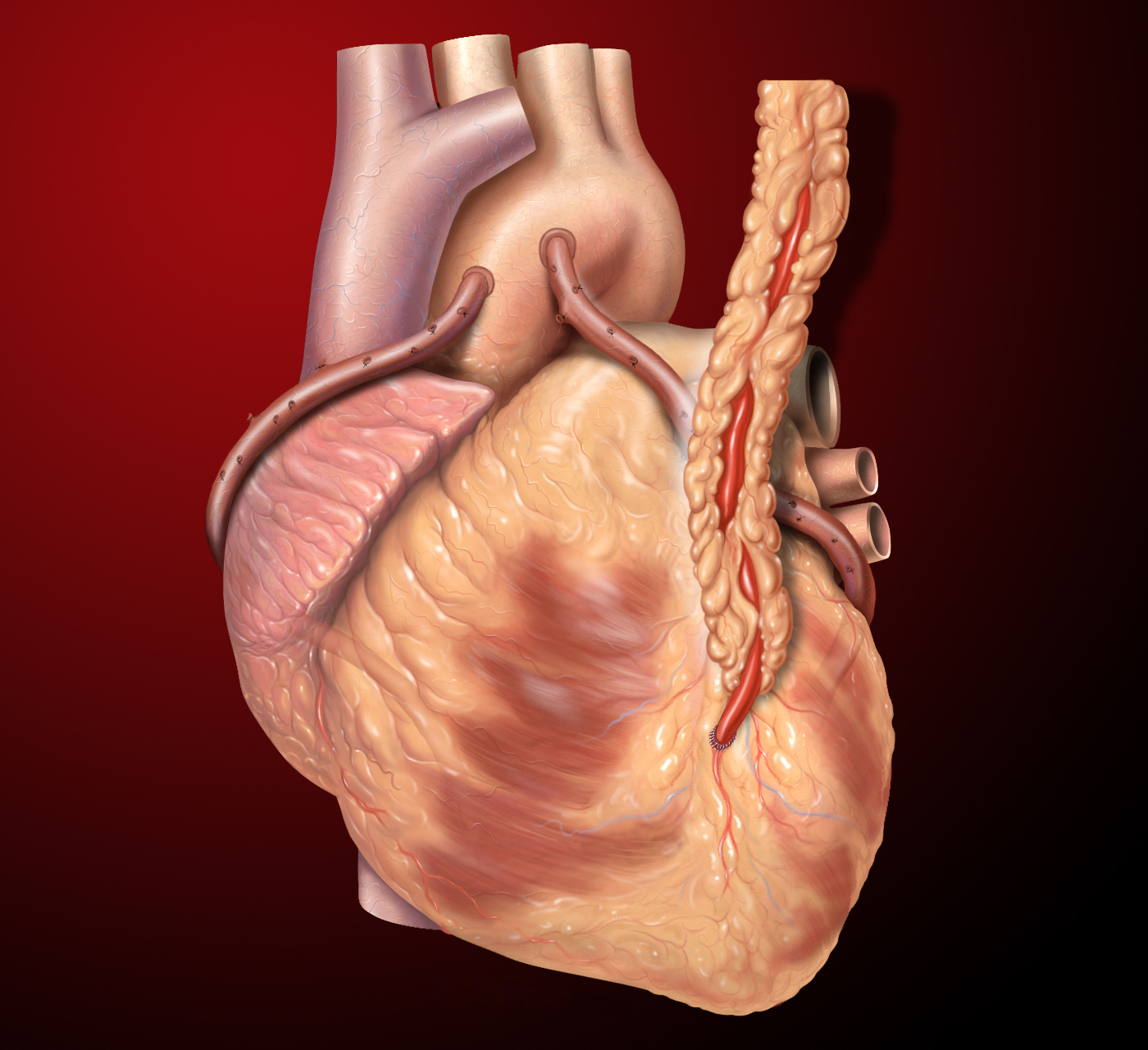 Three coronary artery bypass grafts. Left internal thoracic artery to left anterior descending artery; as well as two saphenous vein grafts.