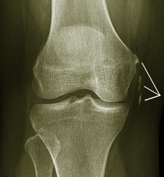 Calcification of MCL
