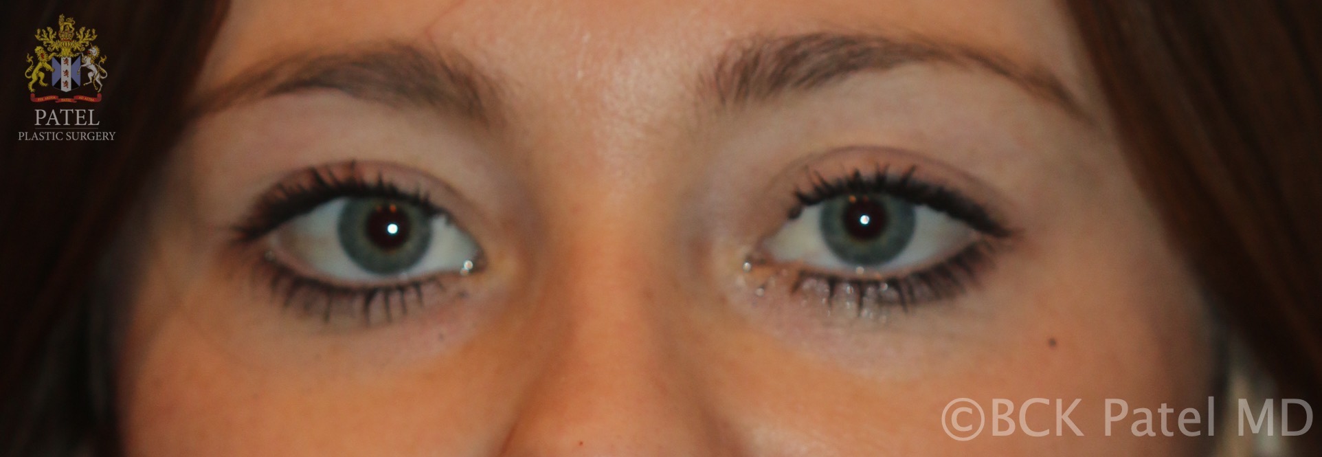 Normal eyelids in a young white woman. Note that the skin creases are not exactly symmetrical, which is normal. Note also that the maximal height of the upper eyelid is just medial to the center of the pupil, but if the patient is converging, it may seem more lateral. Note the fullness just above the upper eyelid crease, which creates a fold and a fullness in the upper lids and below the brows, which gives the youthful appearance.