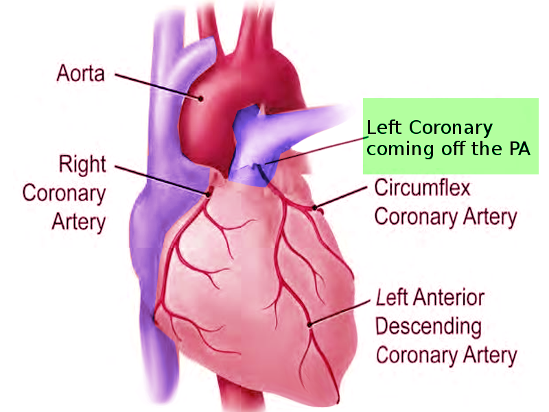 Anomalous left coronary from PA