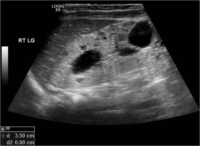 ARPKD in a 6-month -old girl. Enalrged and ecogenic kidney with cysts.