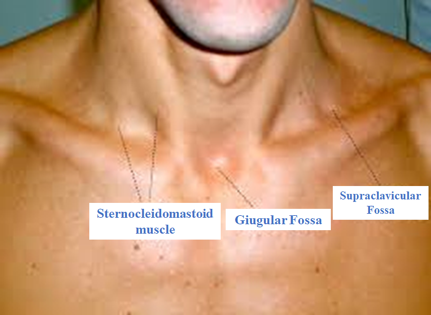 The image shows the supraclavicular fossa, Giugular fossa and the sternocleidomastoid muscle.