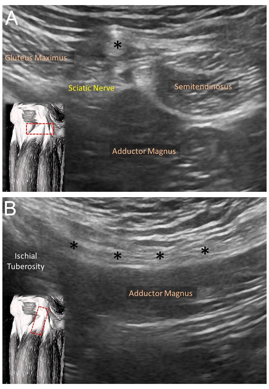 Ultrasound image of the biceps femoris tendon (*) in the (A) short- and (B) long-axis.