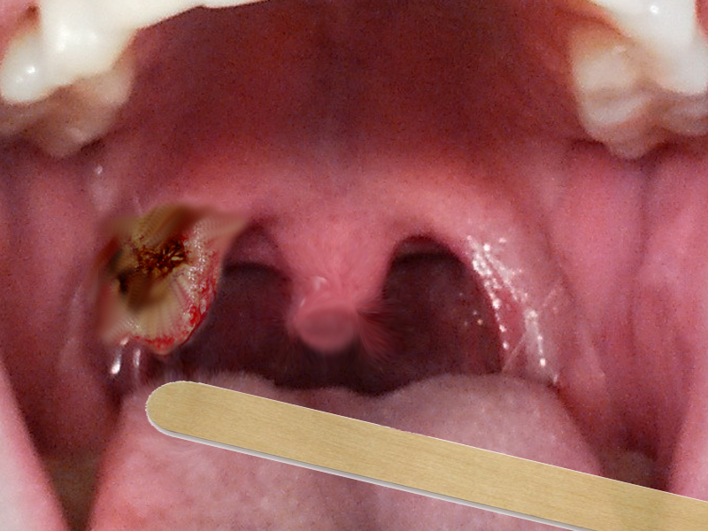 Tonsillar mass