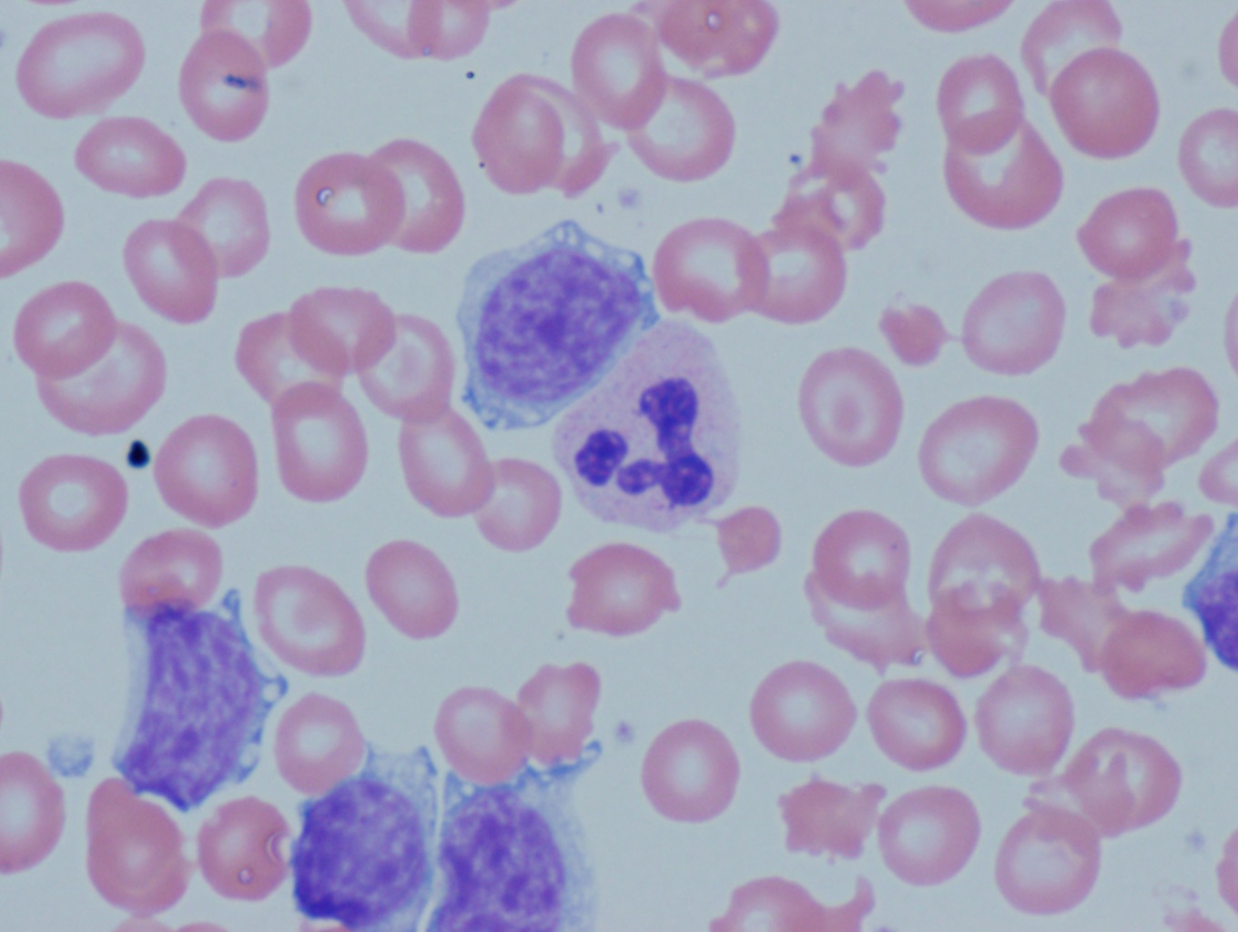 Peripheral blood with lymphocytosis 1000x oil immersion.