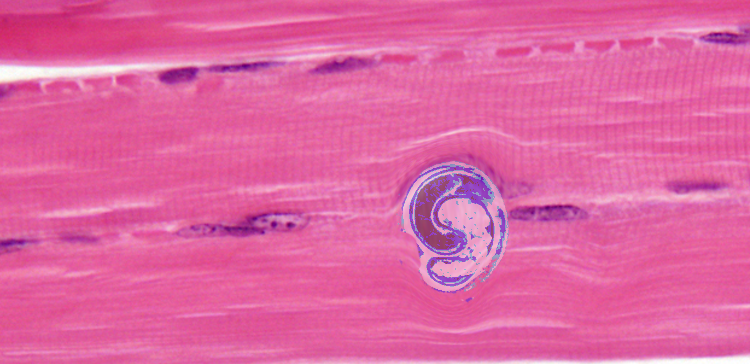 Trichinella Spiralis in skeletal muscle
