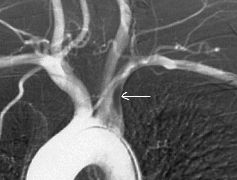 <p>Subclavian Artery Thrombosis on Magnetic Resonance Angiography