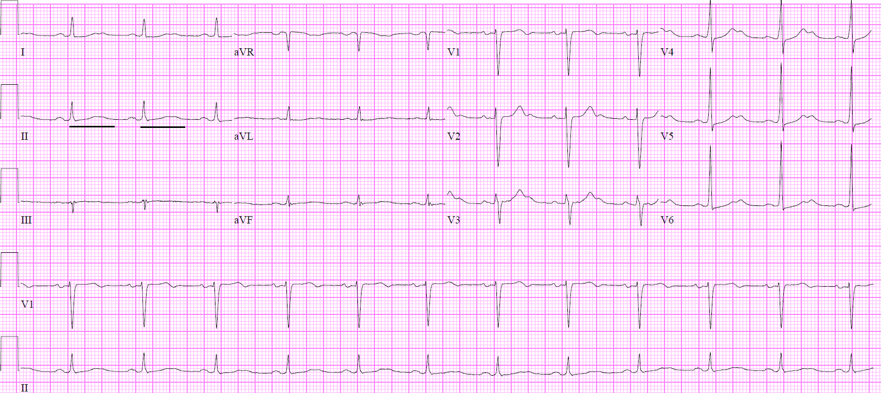 EKG Prolonged QTc