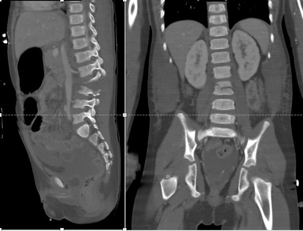 Sagittal and coronal CT images in a 5 year old boy with Chance fracture sustained in a motor vehicle collision while wearing a lap belt. 