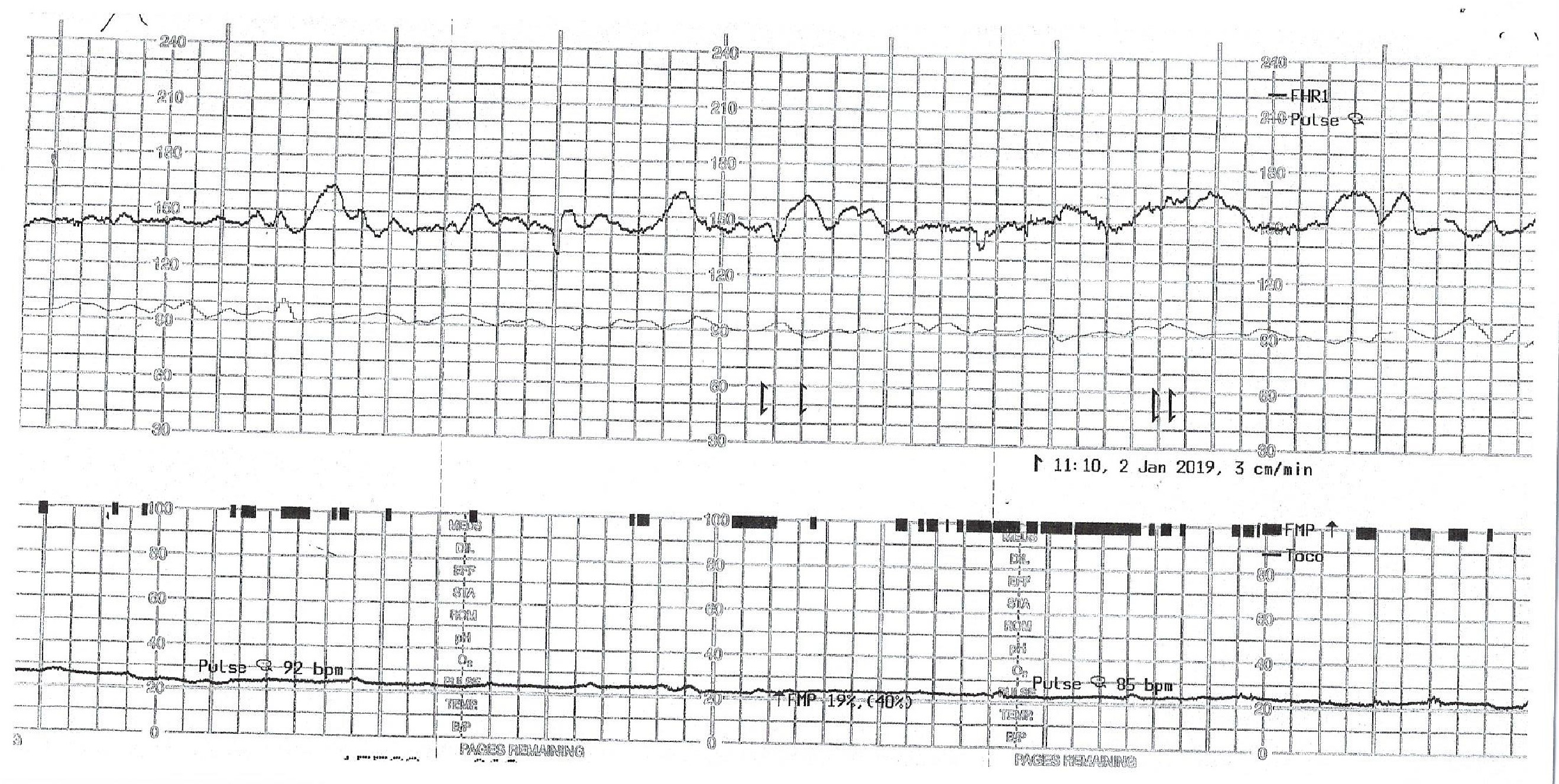 Nonstress test showing fetal heart rate tracing, fetal movement and contraction tracing