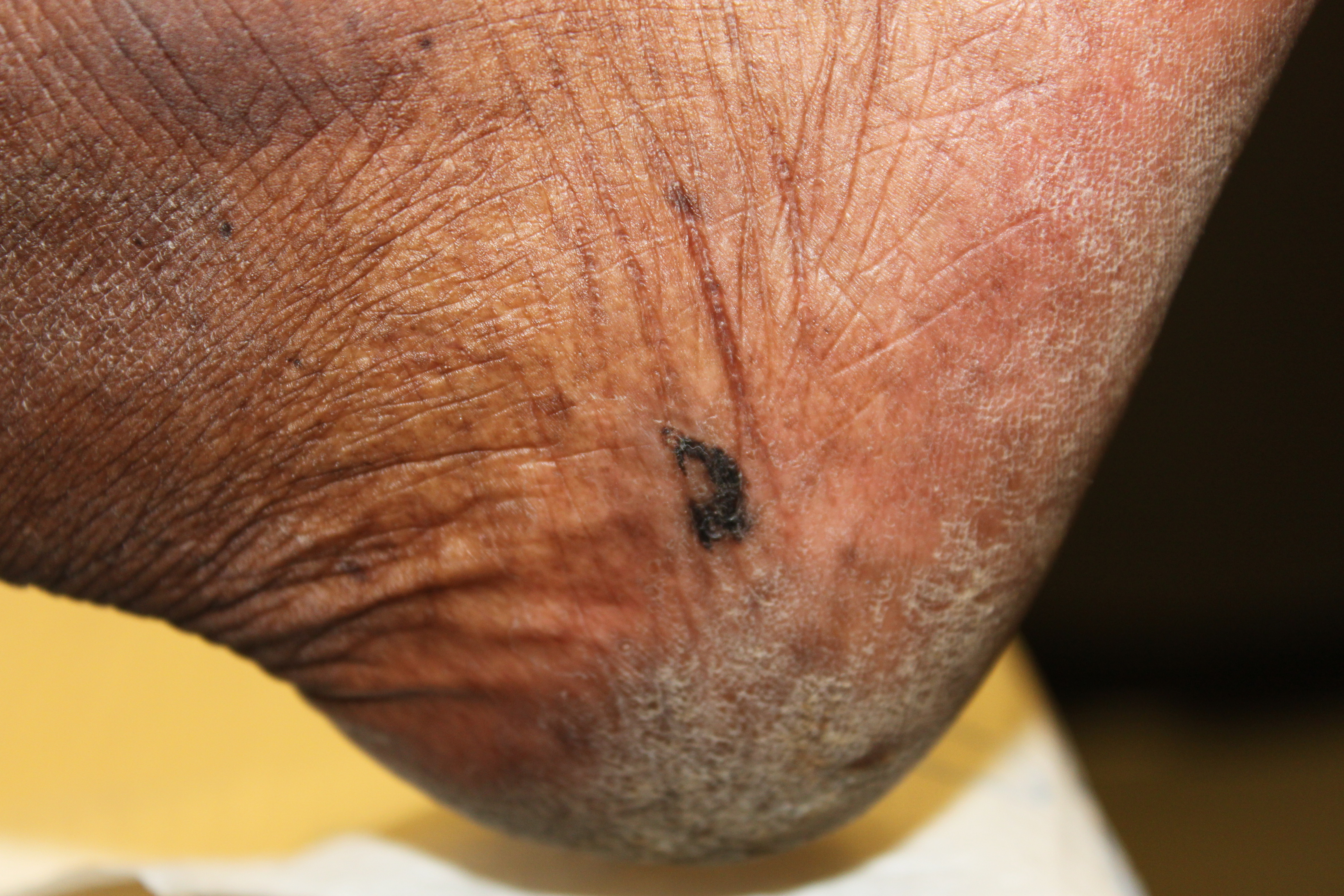 Melanocytic nevus on the right heel of a 62 year old male diabetic.