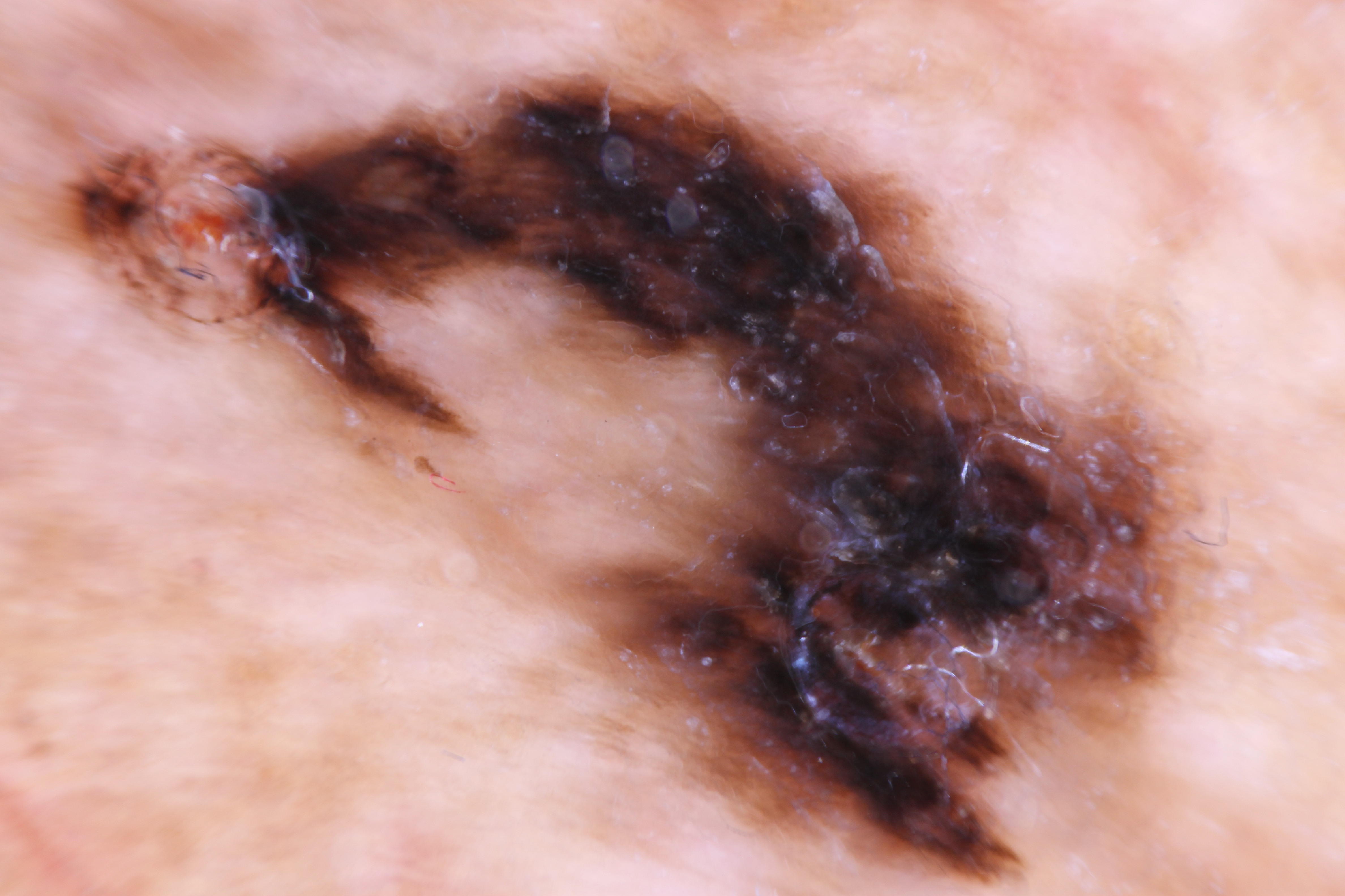 Asymmetric parallel ridge dermoscopic pattern indicative of acral lentiginous melanoma on the heel of 62 year old male.