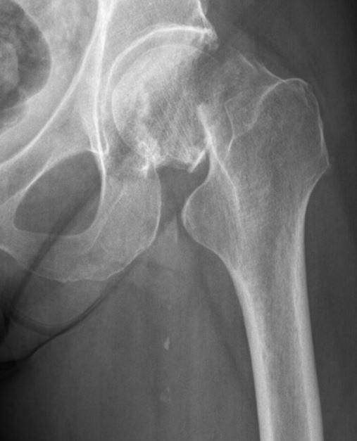 Femoral Neck fracture 