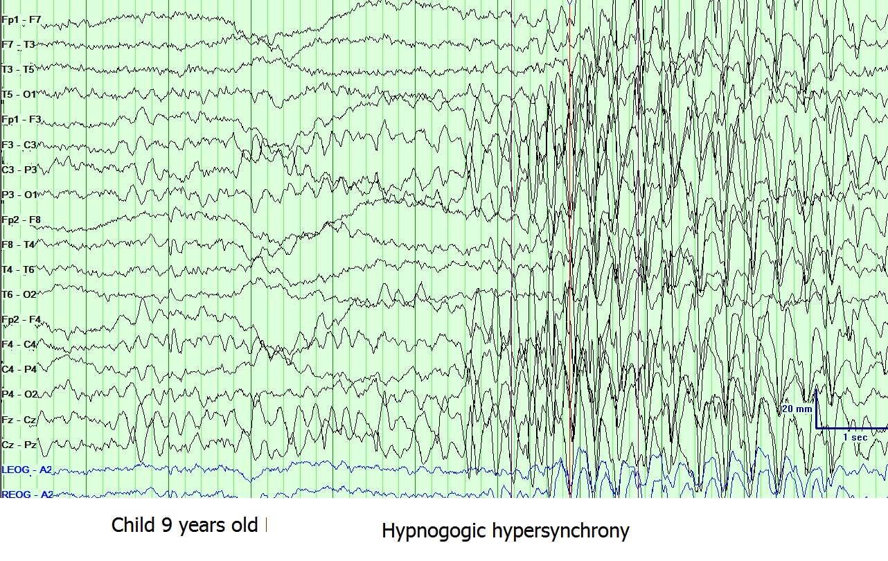 Hypnogogic hypersynchrony in EEG, normal sleep in a 9 years old child