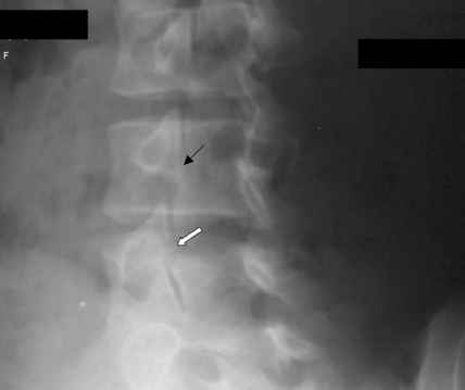 Oblique plain radiograph of the lumbar spine. Black arrow demonstrates normal pars interarticularis. The white arrow demonstrates lucency in the pars interarticularis, suggestive of fracture. The scottie dog features: transverse process being the nose, the pedicle forming the eye, the inferior articular facet being the front leg, the superior articular facet representing the ear, the pars interarticularis equivalent to the neck of the dog. The "collar" represents the pars fracture. 