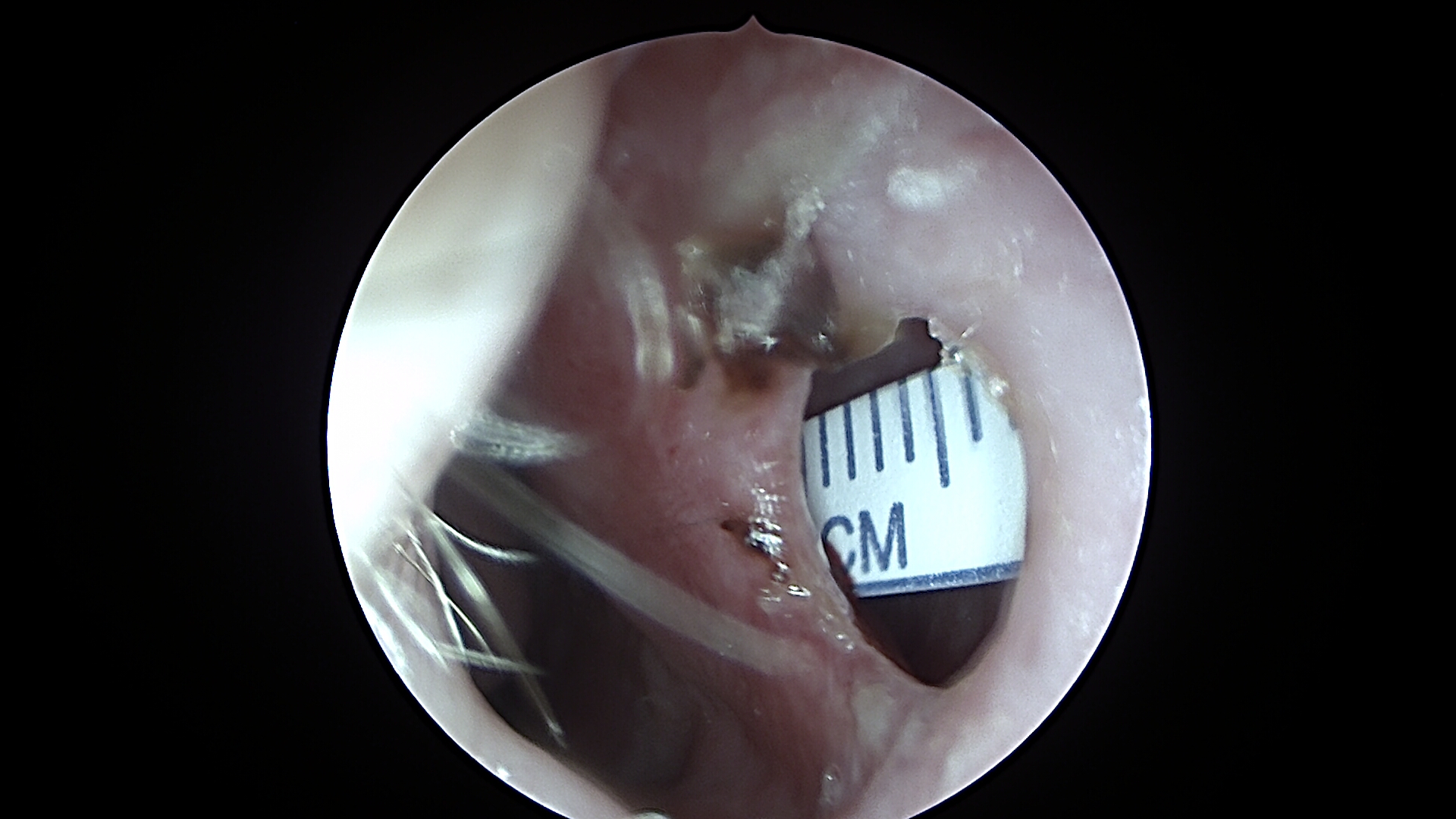 8 mm anterior nasal septal perforation with moderate associated crusting