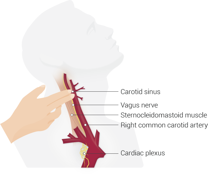 Carotid sinus massage, Carotid sinus, Vagus nerve, Sternocleidomastoid muscle, Right common carotid artery, Cardiac plexus