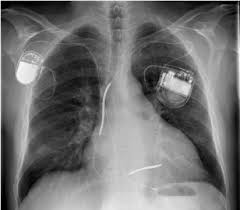 Chest Radiogram Frontal view showing a ICD device (Left) with its leads in RA and RV. There is a Single chamber Pacemaker device also seen (Right) with its lead at RV apex.