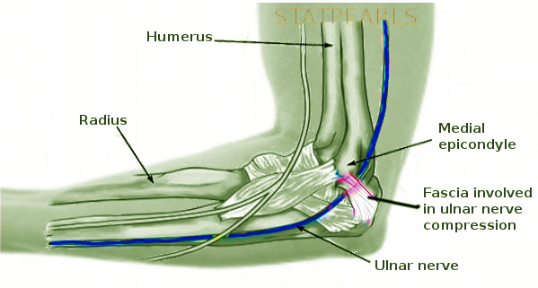 Cubital tunnel syndrome
