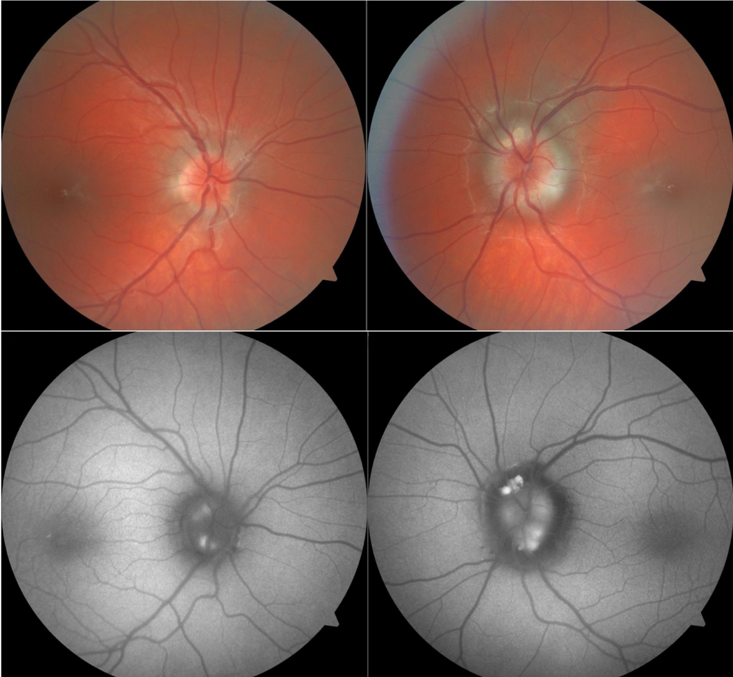 Colour fundus photos of optic nerves with visible optic disc drusen (top). Fundus autofluorescence photos of the same nerves highlights the superficial optic disc drusen which autofluoresce (bottom).
