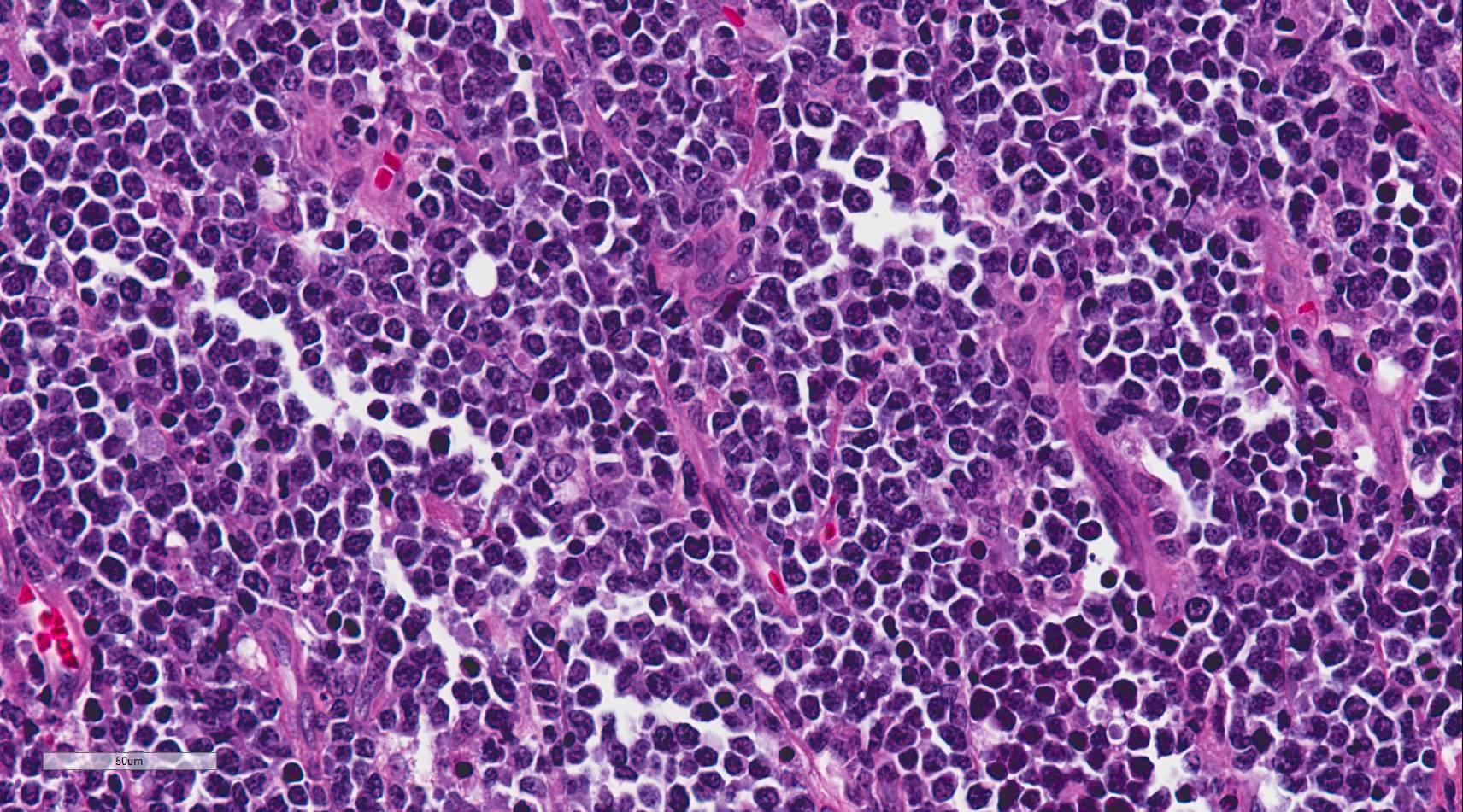 Sheets of intermediate sized lymphocytes in a case of Burkitt lymphoma involving the ileum (400x magnification).