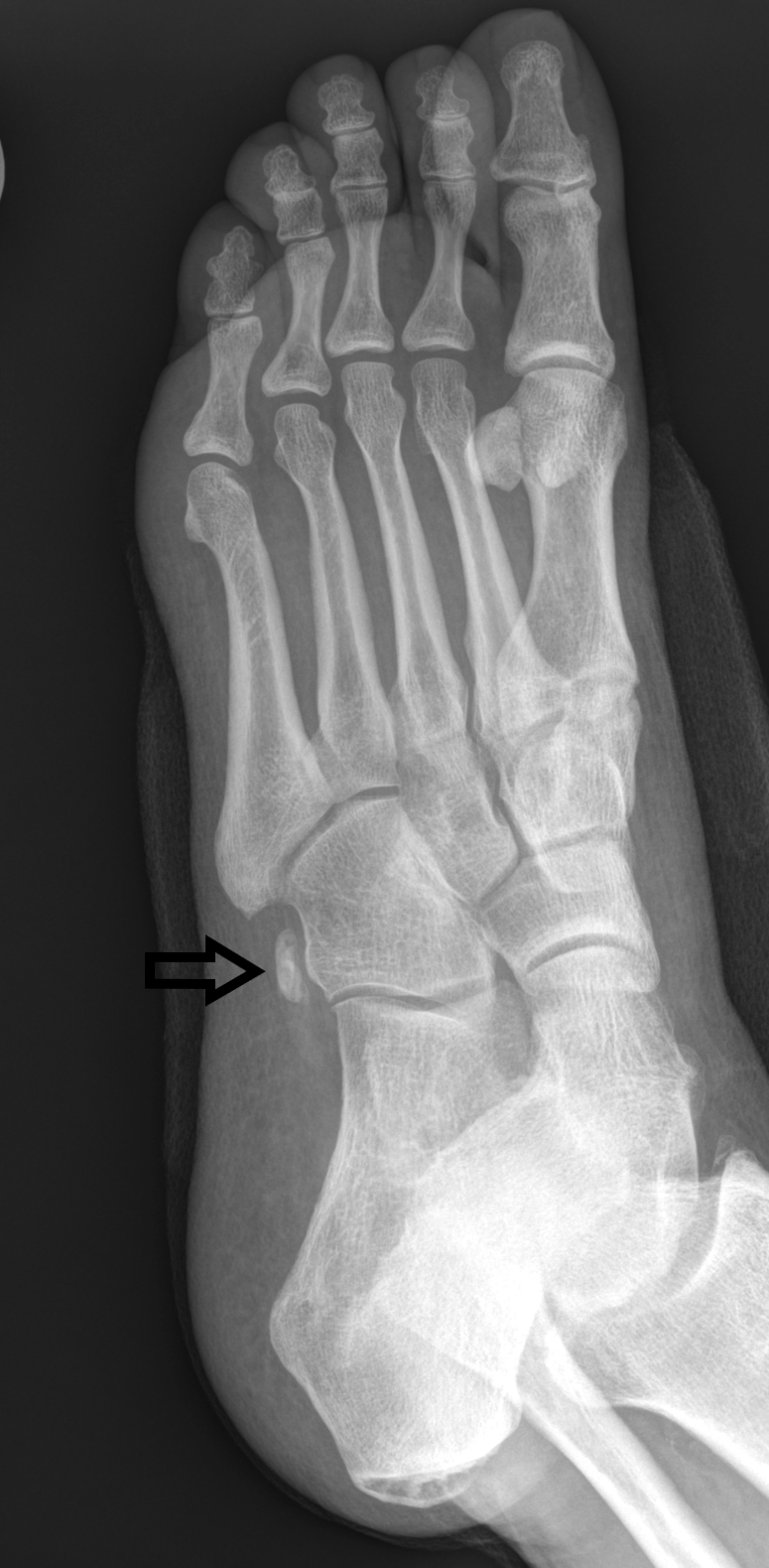 Prominent os peroneus on an oblique radiograph of the left foot. This finding may correlate to osseous enlargement as a chronic stress-related change versus a congenital prominent appearance.