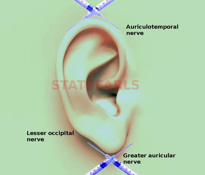 Ear nerve block