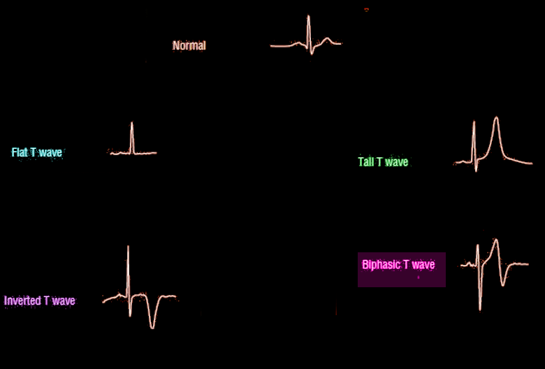 T-Wave morphology