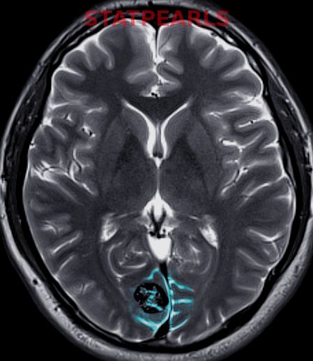Cerebral cavernous hemangioma