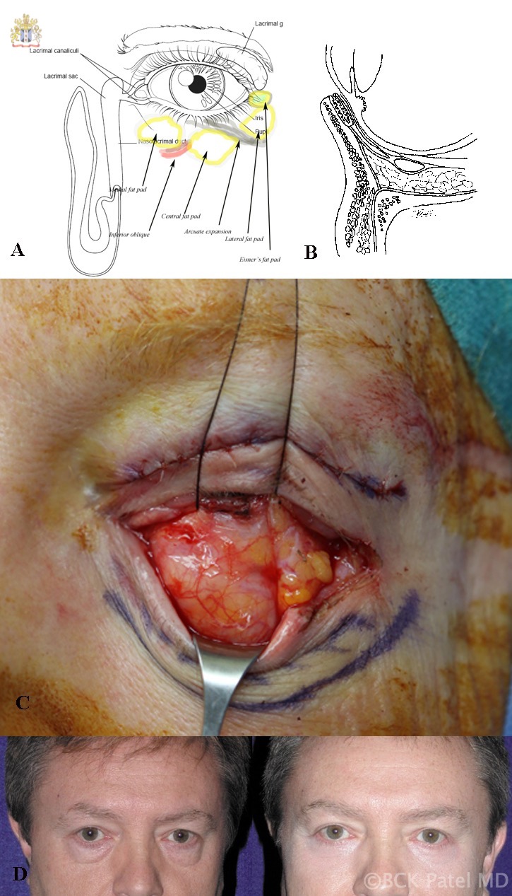 A: Surface anatomy of the left lower eyelid fat pads. B: Cross-sectional anatomy showing the septum and post-septal fat and lower eyelid retractors. C: Traction sutures through the lower eyelid retractors (left eye) showing the medial and central fat pads often appearing as one and the lateral fat pad. D: Before-and-after photographs of transconjunctival lower blepharoplasty in a male.