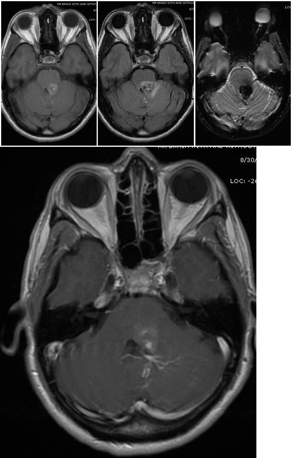 Top three images - Magnetic resonance imaging depicts a cavernous malformation in the left middle cerebellar peduncle of a 42 year old woman who presented with right sided facial numbness and ataxia