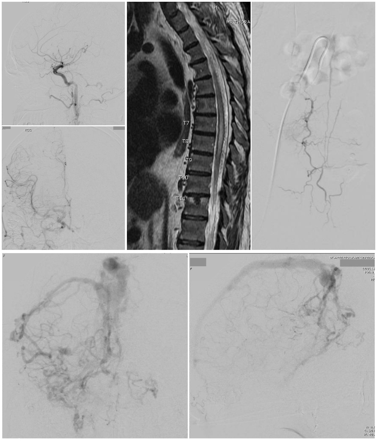 Top Left 2 images - A Cognard type 3 dural arteriovenous fistula is seen on cerebral catheter angiography with arterial phase right common carotid injections, lateral view (top) and anteroposterior view (bottom)