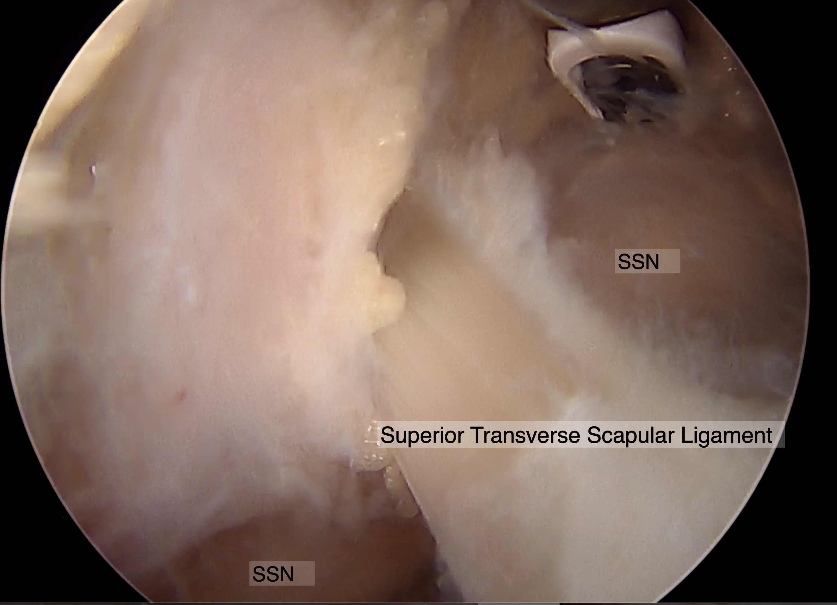 Arthroscopic image of demonstrating the Suprascapular nerve (SSN) coursing inferiorly to the Superior transverse scapular ligament (STSL).  The image demonstrates the SSN's course at the suprascapular notch