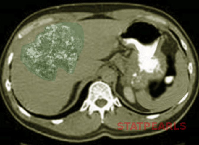 Liver angiosarcoma