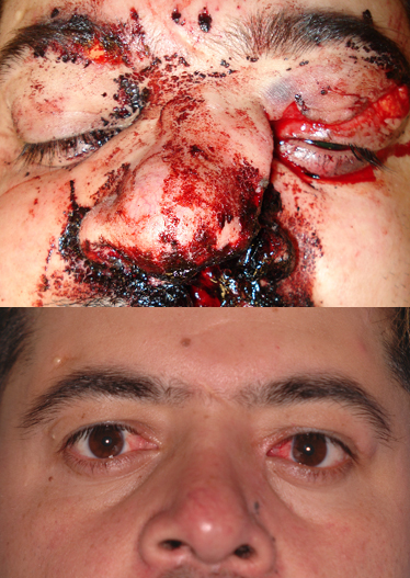 A 32-year old male had naso-orbito-ethmoid (NOE) fracture repair 12 months ago, after a motor vehicle accident. He had open repair of his nasal fractures and transnasal wires placed. He now presents with a complaint of intermittent tearing from the right side since the surgery and a mucoid discharge from the left side. Photos show appearance at time of injury (above) and appearance 12 months after repair.